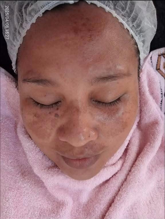 Sebelum Perawatan